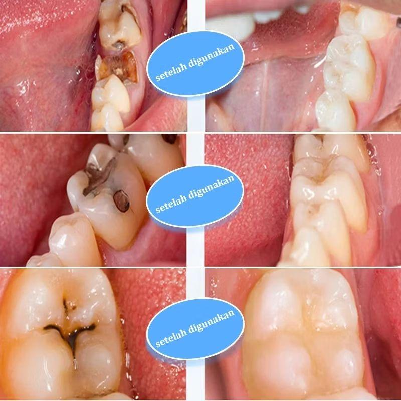 Obat Sakit Gigi Herbal Alami Gumora Ampuh atasi Sakit Gigi & gusi bengkak mulut anak dan dewasa