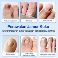 Gambar Obat Jamur Kuku Obat Cantengan Obat Kuku Rusak Pembersih Kuku Kaki Hitam Fungal Nail Treatment Fungal Nail Patches - 21 tablet per kotak dari KRVELLA Kab. Bogor 3 Tokopedia