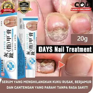 Oles Kuku Cantengan Obat Jamur Kuku Perawatan Jamur Kuku Paronychia Perawatan Lumut Kuku Berjamur Penghilang Jamur Paronychia Onychomycosis obat Jamur Kuku 20g Kaki Tangan Berjamur Berdarah Bengkak Bernanah Bau Propolis Kuku obat