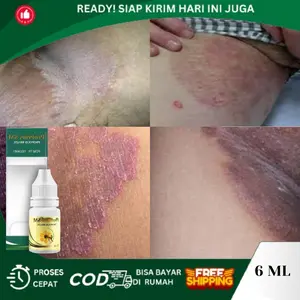 Gatal Selangkangan, Selangkangan Hitam, Selangkangan Gatal Dan Hitam, Ruam Merah Selangkangan, Pemutih Selangkangan, Penghilang Hitam Gatal Selangkangan, Gatal Jamur Di Kemaluan