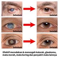 Gambar Obat tetes mata Katarak eye drop Tetes mata gatal Vitamin Mata Kesehatan Mata Obat Mata Minus Untuk Mata Buram - 1 pcs dari Cus.ID Mall Kab. Bogor 4 Tokopedia