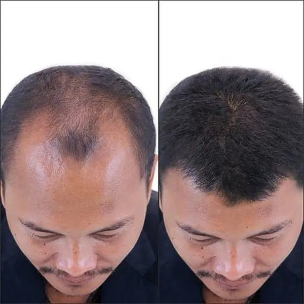 COPILOT HAIR BOOSTER SERUM Penumbuh Rambut Botak, Pelebat rambut, mempercepat pertumbuhan rambut 8