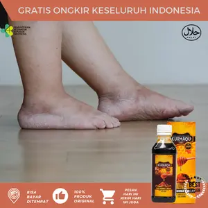 Bengkak Pada Kaki, Kaki Bengkak Dan Nyeri, Kaki Bengkak Karena Asam Urat, Jamu Pengempes Kaki Bengkak Sebelah Sari Kurma Kurmaqu Asli Original