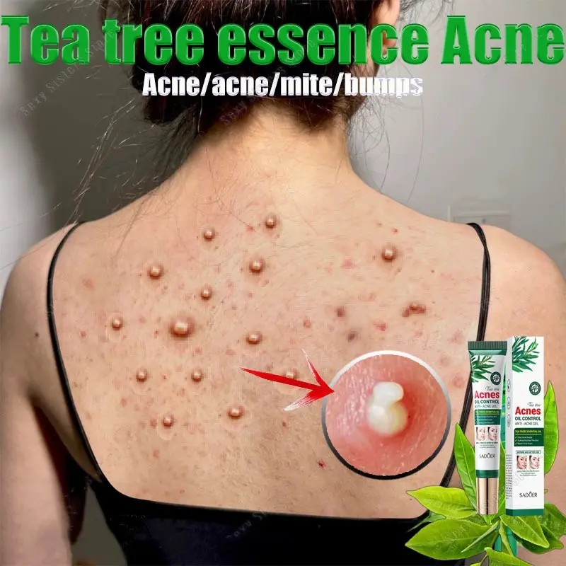 Acne Gel tea tree serum oil control soothing moisturizing mild skin care original herbal remedy acne and scars 20g