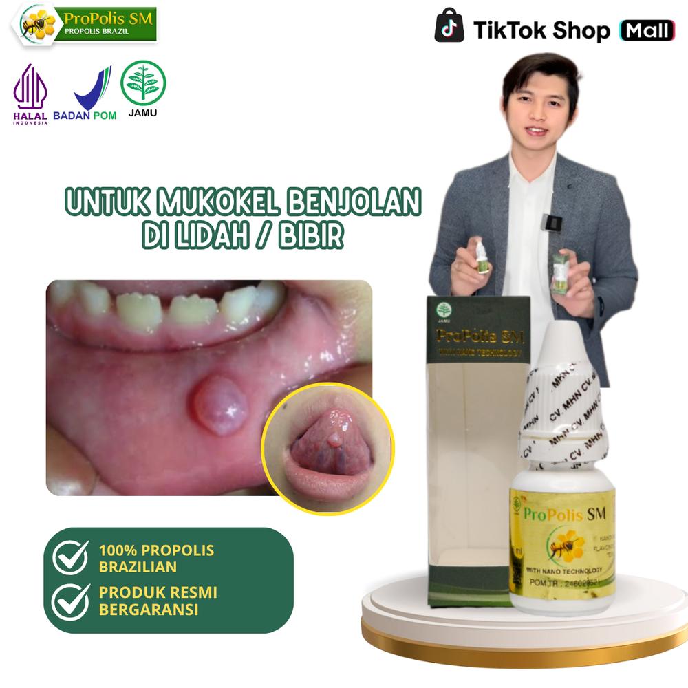 Propolis SM- Untuk Pengempis Benjolan Di Lidah / Benjolan Di Bibir Mukokel (Sumbatan Kelenjar Liur)