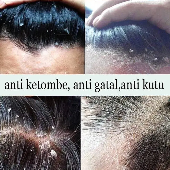 SHAMPOO ANTI-DANDRUFF OIL CONTROL anti kelemumur penghilang kelemumur mengawal minyak menguatkan akar rambut