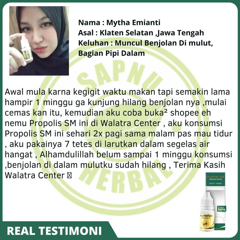 Propolis SM - Untuk Penghilang Kelenjar Mucocele / Ranula Benjolan di Bawah Lidah, Di Mulut / Bibir 2