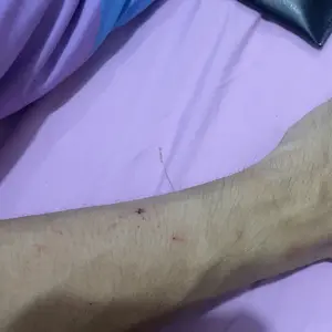 PAKET HEMAT GATAL KULIT JAMUR,GATAL ALERGI,KURAP,KUDIS,EKSIM BASAH EKSIM KERING