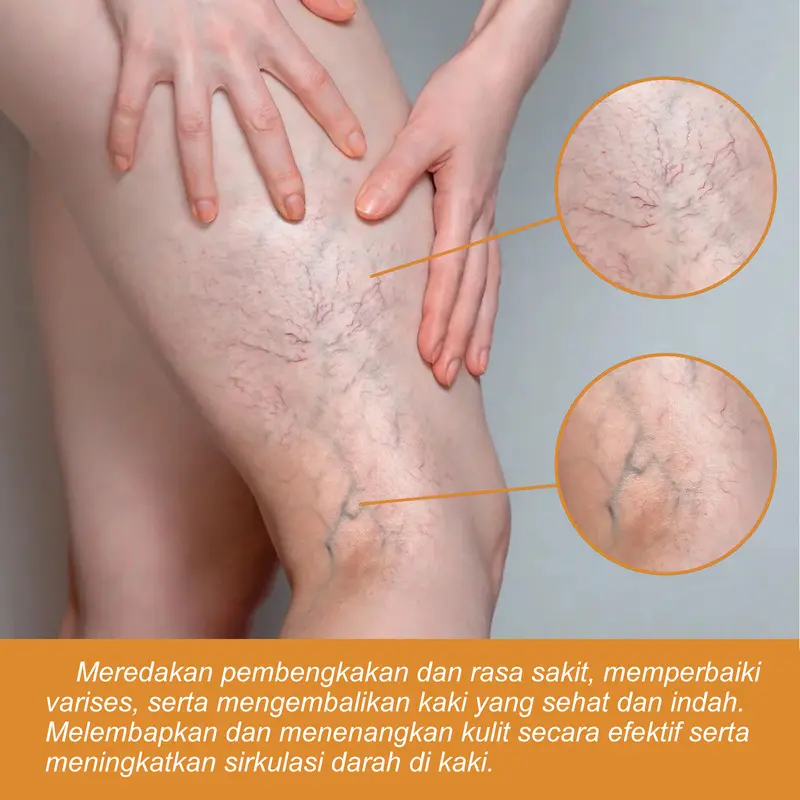 South Moon Krim Varises Vena Bulan Selatan mengurangi rasa sakit, bengkak, varises, vena kaki dan memperbaikinya, obat varises merah 3