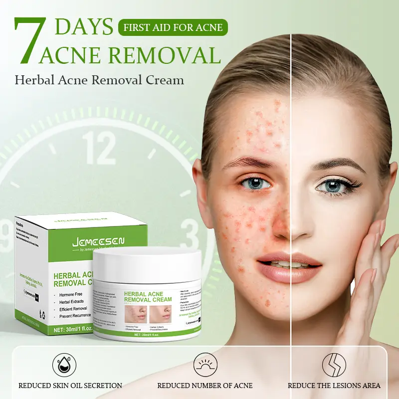 Jemeesen Herbal Acne Cream Clear Breakouts Reduce Redness Soothe Skin Natural Effective Treatment for Blemishes Skincare