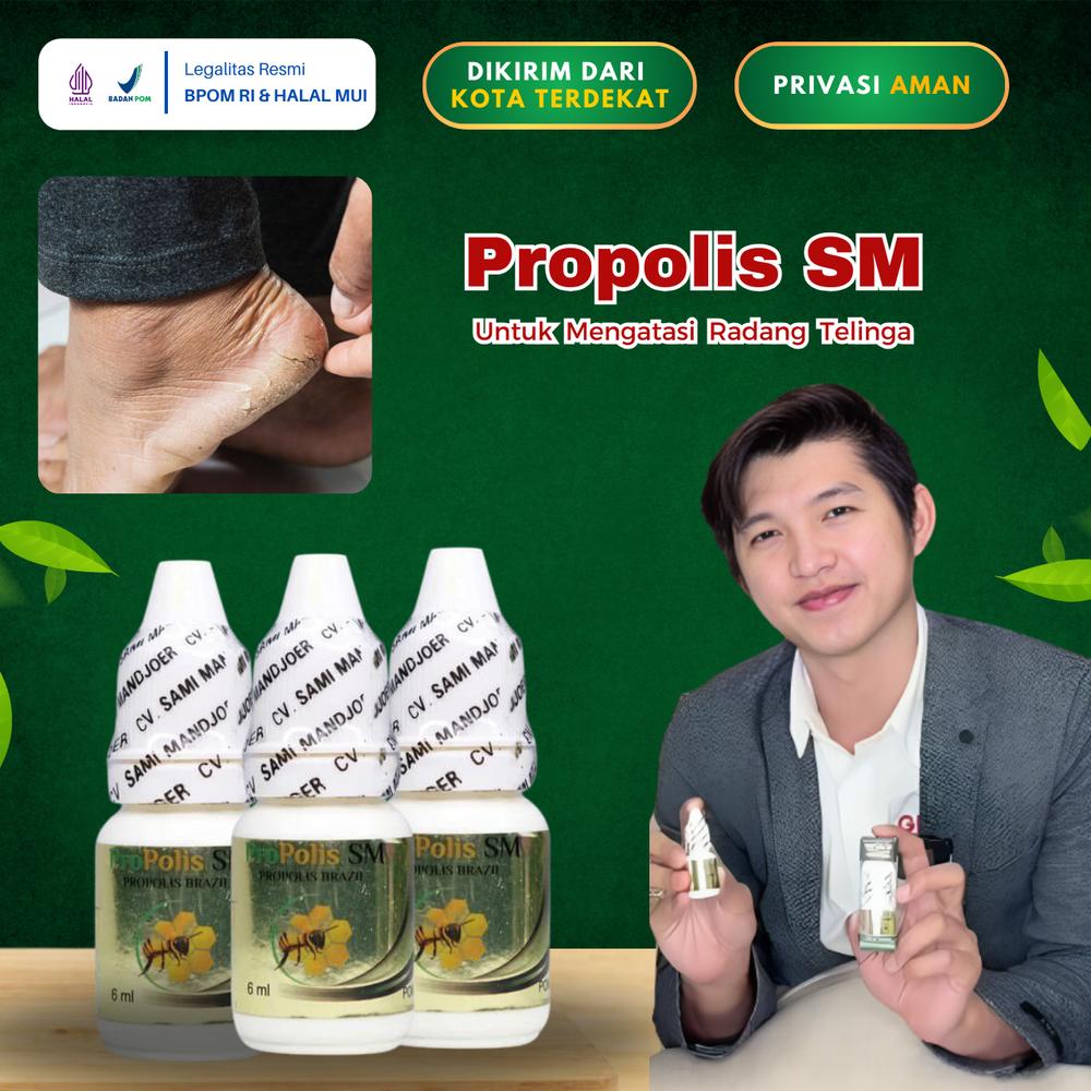 Propolis SM  Cairan Mengatasi Tumit Kaki Pecah Pecah, Telapak Kaki Kering, Kaki Pecah Dan Kasar Kapalan, Pitted Keratolysis