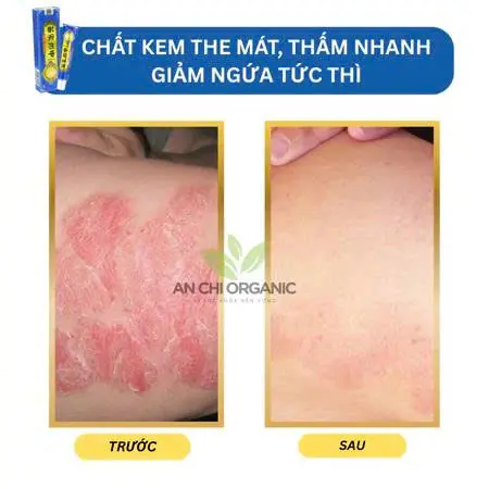 ( COMBO 10 TUÝP ) Kem Bôi Viêm Da Cơ Địa Dứt Điểm Lác Đồng Tiền, Hắc Lào, Á Sừng, Côn Trùng Đốt Hiệu Quả - BÀ LÃO XANH 7