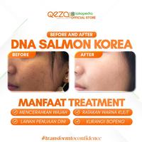 Gambar COMBO DNA SALMON KOREA + PICO LASER REJUVE + FACIAL Kerutan Perawatan Wajah Membersihkan dari qeza.clinic Kab. Sleman 2 Tokopedia