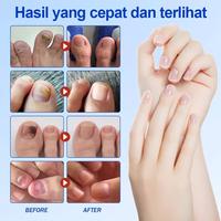 Gambar Obat Jamur Kuku Obat Cantengan Obat Kuku Rusak Pembersih Kuku Kaki Hitam Fungal Nail Treatment Fungal Nail Patches - 21 tablet per kotak dari KRVELLA Kab. Bogor 4 Tokopedia