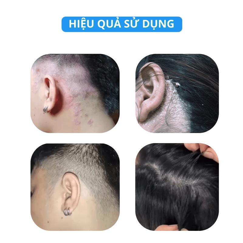 Product Introduction of Chuyên Nấm Gàu Viêm Da Tiết Bã - Dầu Gội Kem Bôi Canova Rivescal DS Nhập Khẩu Chính Hãng Từ Ý 29