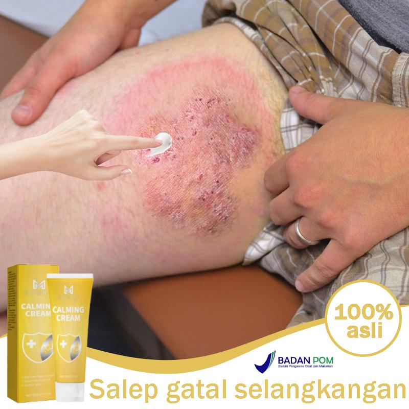 Salep gatal selangkangan Salep gatal china paling ampuh Obat kurap 20g Salep gatal eksim paling ampuh Obat gatal selangkangan Obat Gatal Kulit Salep Alergi Kulit Gatal Salep Eksim Jamur Dermatitis Pso