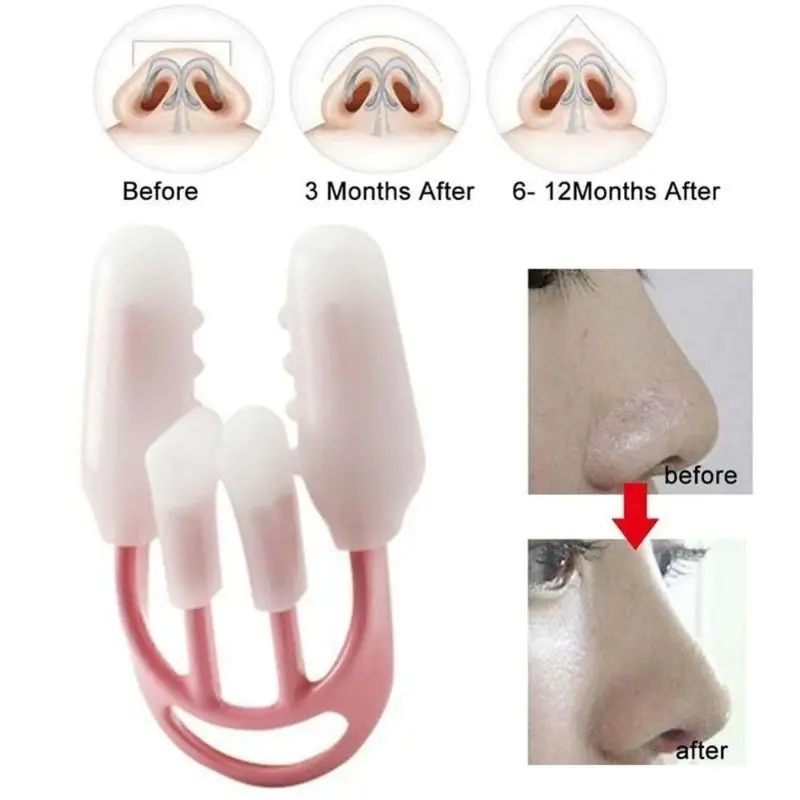 Nose Up Clipper Treatment 2 in 1 Alat Therapy Pemancung Hidung Permanen 4