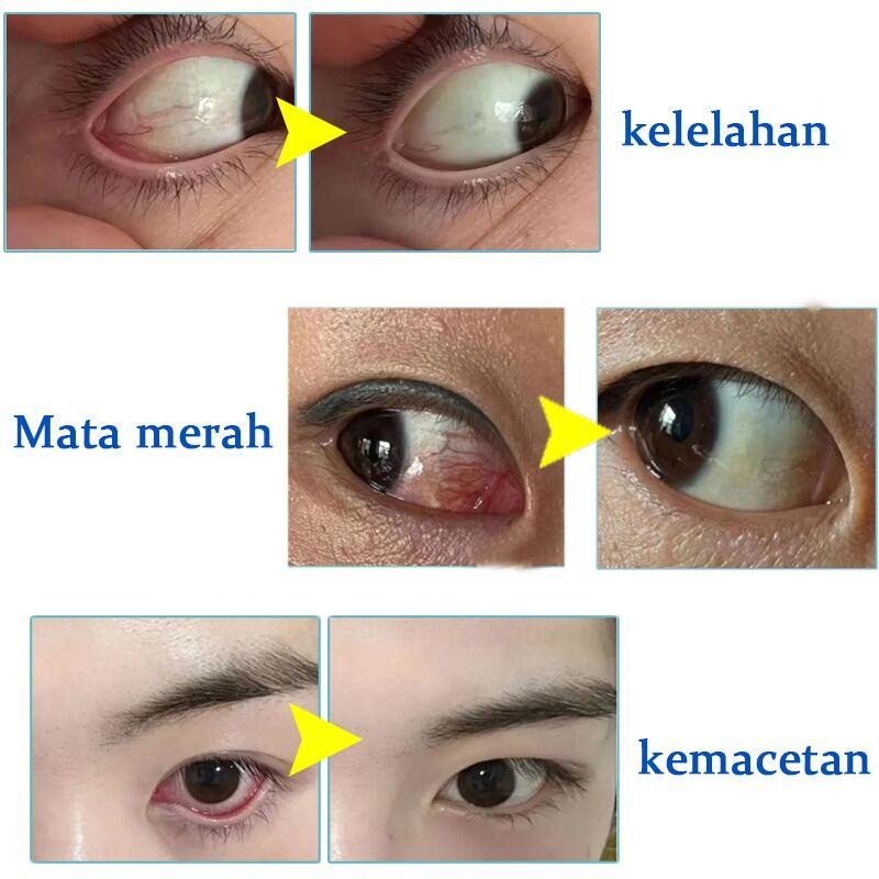 Eye Drops for Cataracts, Dry Eyes, Eye Pain, Red Bloodshot Eyes, Eye Strain 3