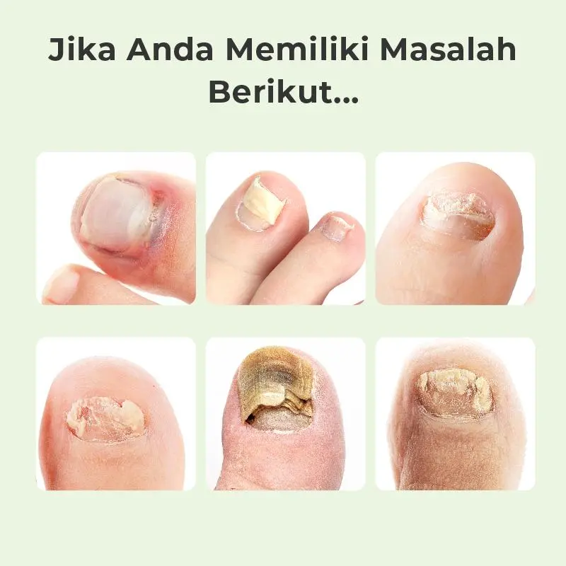 【A】Kreain Nature Nail Care Essence Esens Perawatan Kuku  Ekstrak Tea Tree dan Jahe untuk Perawatan 7 Hari 1