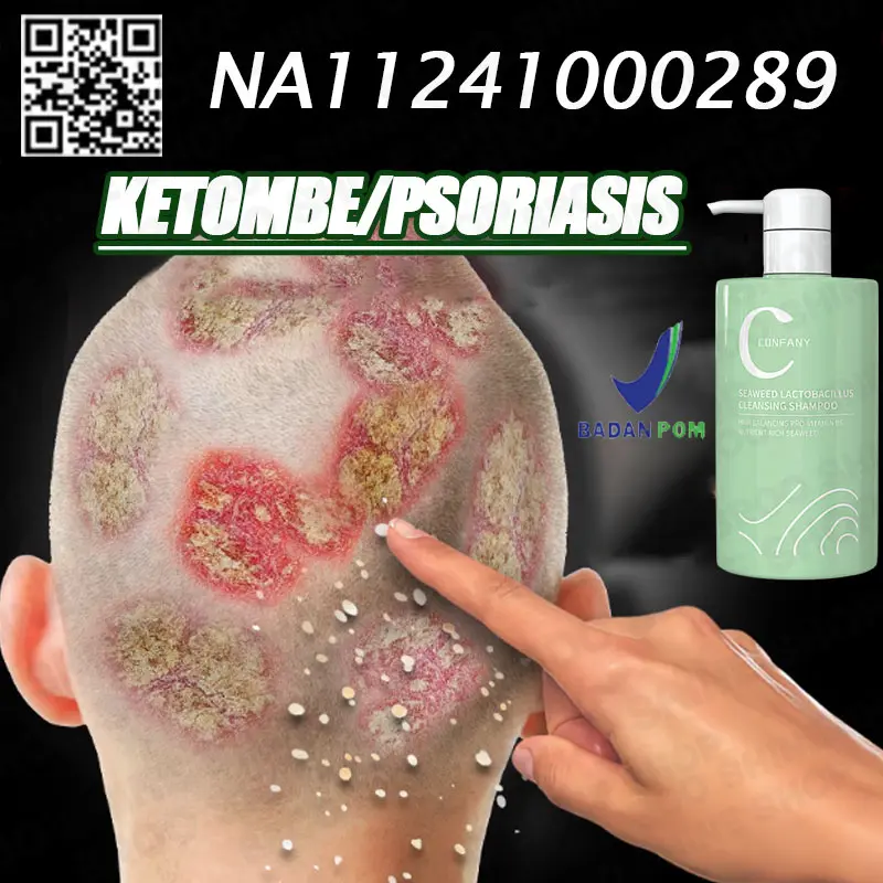 Shampoo Penghilang Ketombe Shampoo Psoriasis Anti Ketombe Dan Gatal Garam Laut Sampo Ketombe Shampoo Kutu Rambut Pengobatan Tungau Kulit Kepala Kering Dan Ketombe Mengontrol Minyak 0