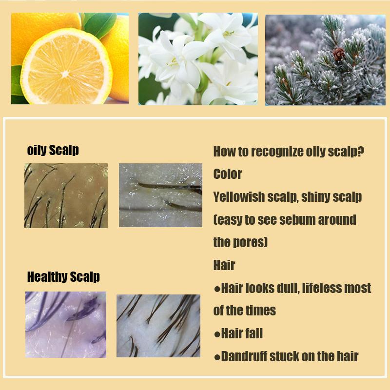 Shampo anti ketombe Penghilang ketombe berkerak dan gatal psoriasis kulit kepala Oil control Kulit kepala gatal Shampoo rambut 8