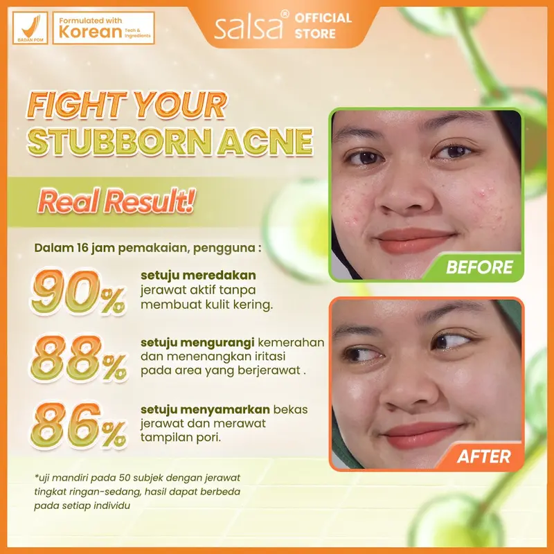 SALSA ACNE SPOT – obat jerawat salep jerawat ance gel anti acne cream | obat totol jerawat pustula papula bruntusan|acne treatment 1