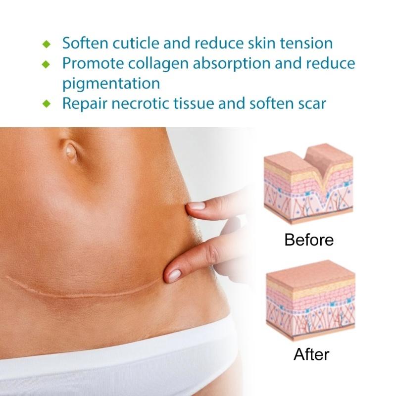 ⭐️ORI⭐️ELAIMEI Silicone Scar Sheets Patch Penghilang Keloid Tambalan Stretch Mark Surgery Scar Removal Silicone Repair Tape 4cm x 1.5m - Ready 8