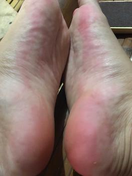 Product Review of JC Callus Remover for Damaged and Cracked Heel With Wooden Foot File Eucalyptus Scented At Home Foot Spa Session Soft  Moisturizer Dry Skin Oil Peeling Nails Moisture Hydrate Hydrating from j**4 3