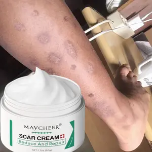 Krim penghilang bekas luka Cream penghilang bekas luka Penghilang bekas luka hitam Menghilangkan bekas luka koreng Penghilang bekas gigitan nyamuk bekas luka di kaki keloid bekas luka bakas dan stretch mark Bekas Luka Luka Jahitan Bekas