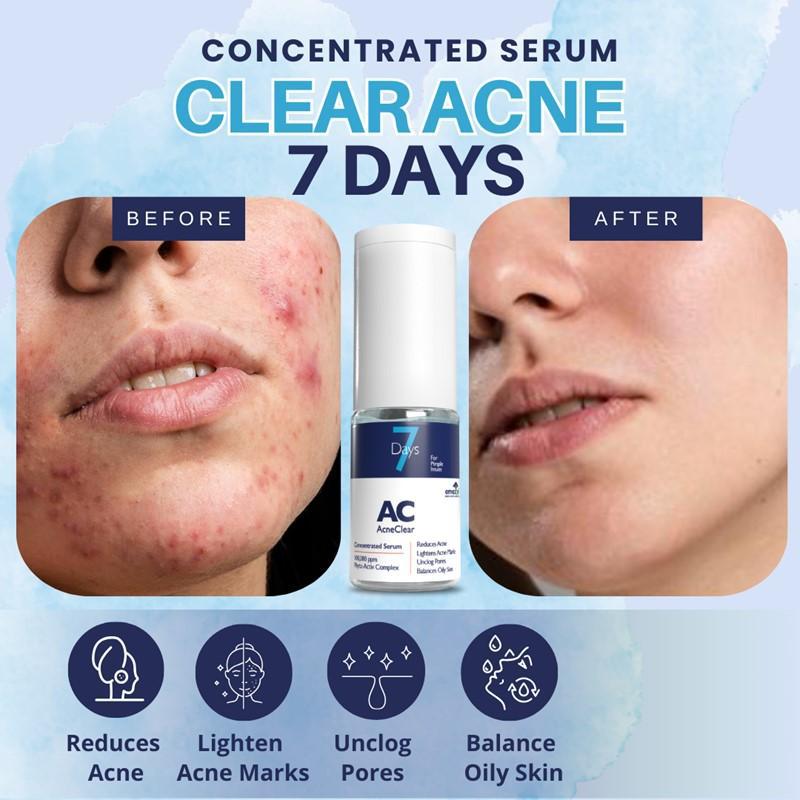 How to Make a Turmeric Face Mask for Acne Prone Skin