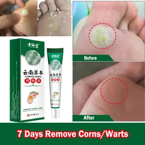 Kapalan Corn Patch Removal 20g Penghilang Kutil Kapalan Mata Ikan - Perawatan