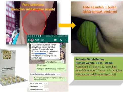 TYPHONIUM PLUS Obat Herbal Alami Kanker Tumor Miom Kista PCOS FAM