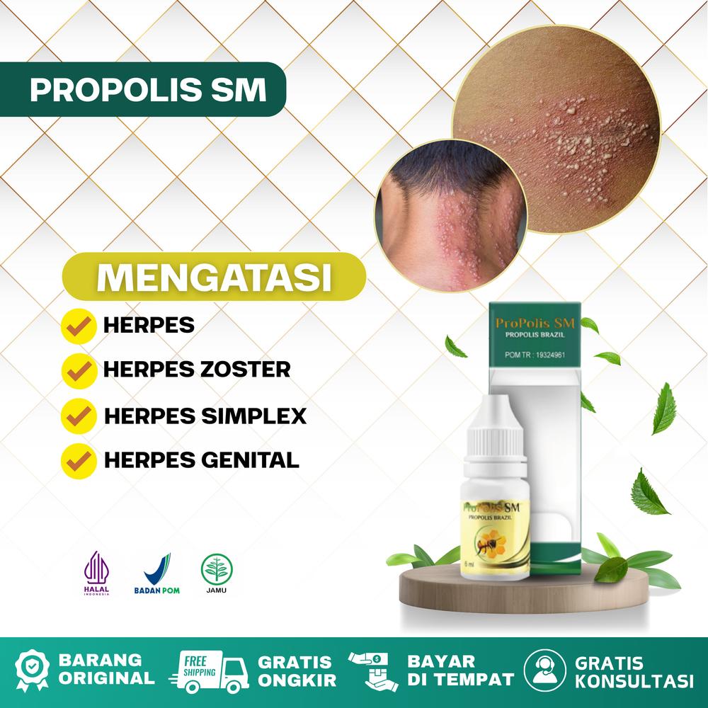 Propoli SM untuk Mengatasi herpes zoster, herpes Tetes di kulit, herpes genital, gatal gatal, ruam, herpes simplex, budug di kulit, borok di kulit, herpes di Tubuh