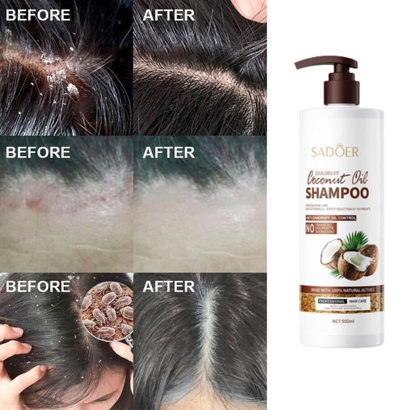 Shampo anti ketombe Penghilang ketombe berkerak dan gatal psoriasis kulit kepala Oil control Kulit kepala gatal Shampoo rambut 2