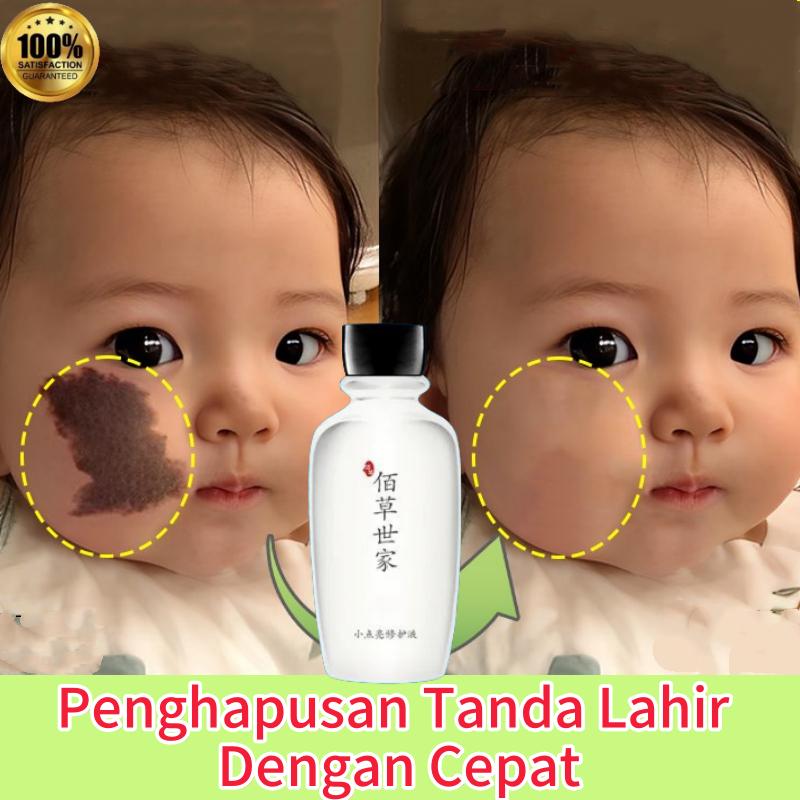 Obat Penghilang Tanda Lahir Penghilang tanda lahir coklat Hapus melanin yang diendapkan Memudarkan Tanda Lahir Hitam Merah Coklat Di Wajah Tanda Lahir Merah Menonjol Pada Bayi Penghilang Tanda Lahir P