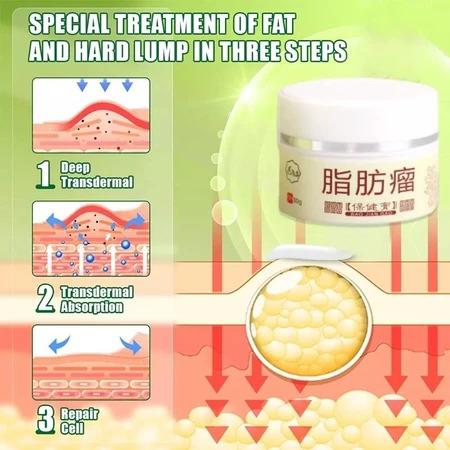 Lipoma Removal Cream Penghilang Kista & Lipoma Atasi Benjolan Lipoma Cepat Kempes Hilangkan Kista Lemak Kempes Tanpa Bedah