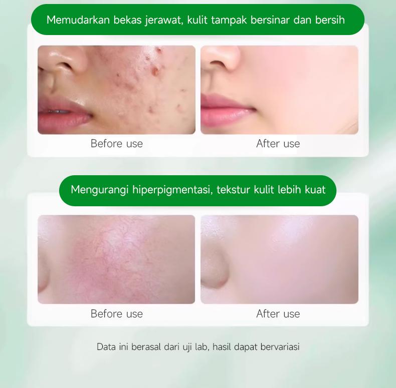 Product Introduction of （T1）BPOM.Beli 2 Gratis 1.Challenge 7 Hari Jerawat Hilang,CINSULIN Obat Jerawat Herbal Ekstrak Alami Cepat Hilangkan Komedo & Jerawat Meradang  BPOM Certified  Aman untuk Remaja & Kulit Sensitif Berjerawat Wajah Gatal Beruntusan 12
