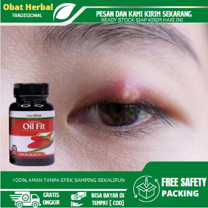 Solusi Untuk Mengatasi Mata Kalazion, Penghilang Benjolan Di Kelopak Mata, Mata Bintitan, Mata Bengkak, Timbilan Atasi Dengan Oilfit