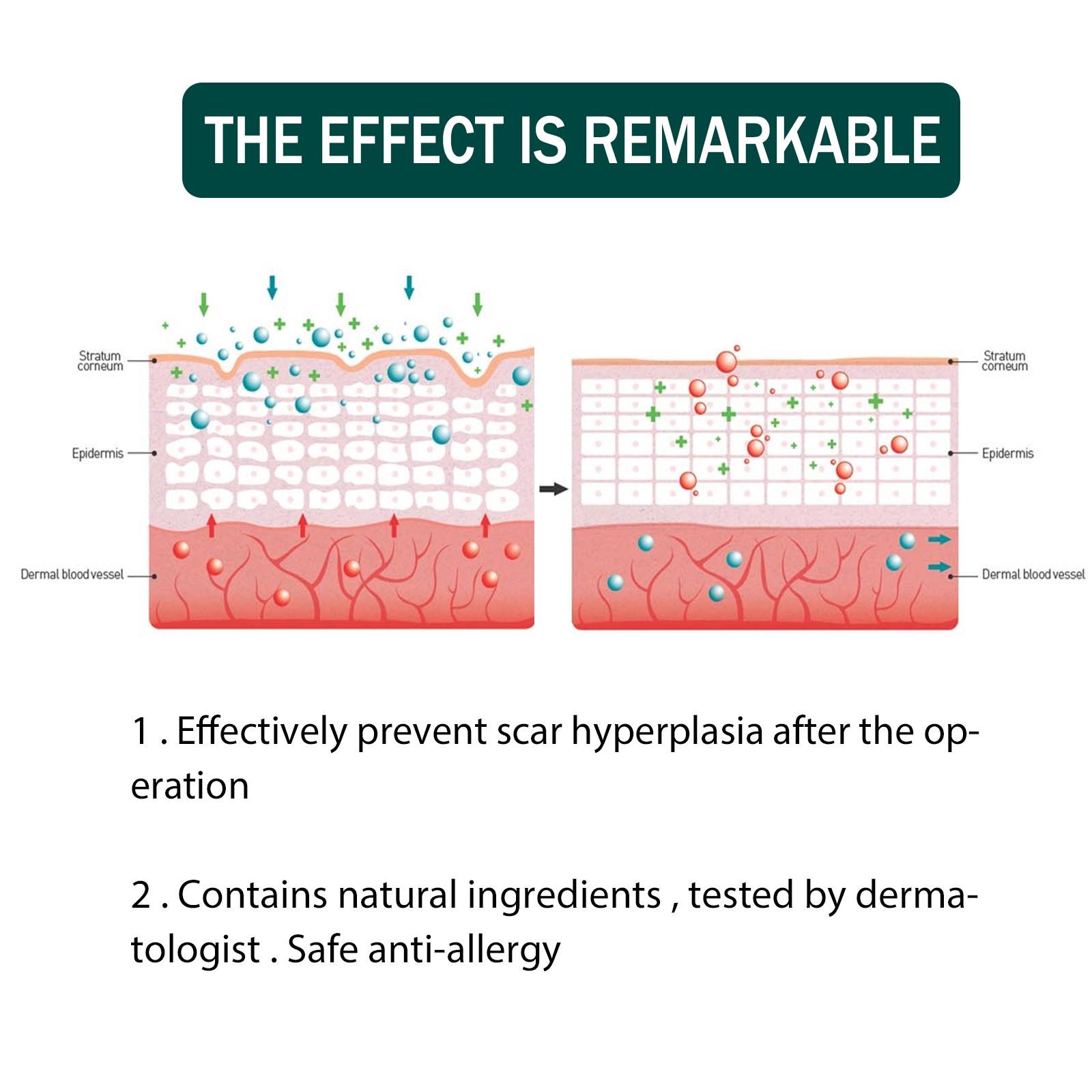 EELHOE Silicone Scar Sheets 1Roll Plester Silikon Penghilang Keloid Bekas Luka Silicon Keloid Plester Bekas Luka