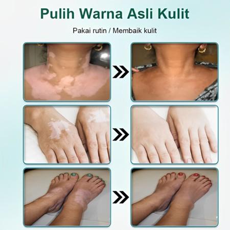 salep khusus bercak putih vitiligo salep vitiligo, bercak-bercak putih vitiligo cream bercakputih penyakit kulit putih/panu putih/kudis putih/lepra putih salep khusus bercak putih vitiligo salep vitiligo, bercak-bercak putih vitiligo cream bercakputih penyakit kulit putih/panu putih/kudis putih/lepra putih