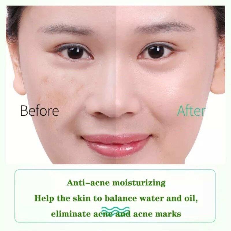 Product Introduction of Organic Aloe Vera Gel For Face Body Skin Care Moisturizer Soothing Acne Dryness Anti Aging Natural Hydration Treatment Deep Nourishment Sensitive Skin Solution Moisturizer Hydrating Lotion Oily Skin Type Skincare Sunburn aloe  vera 20
