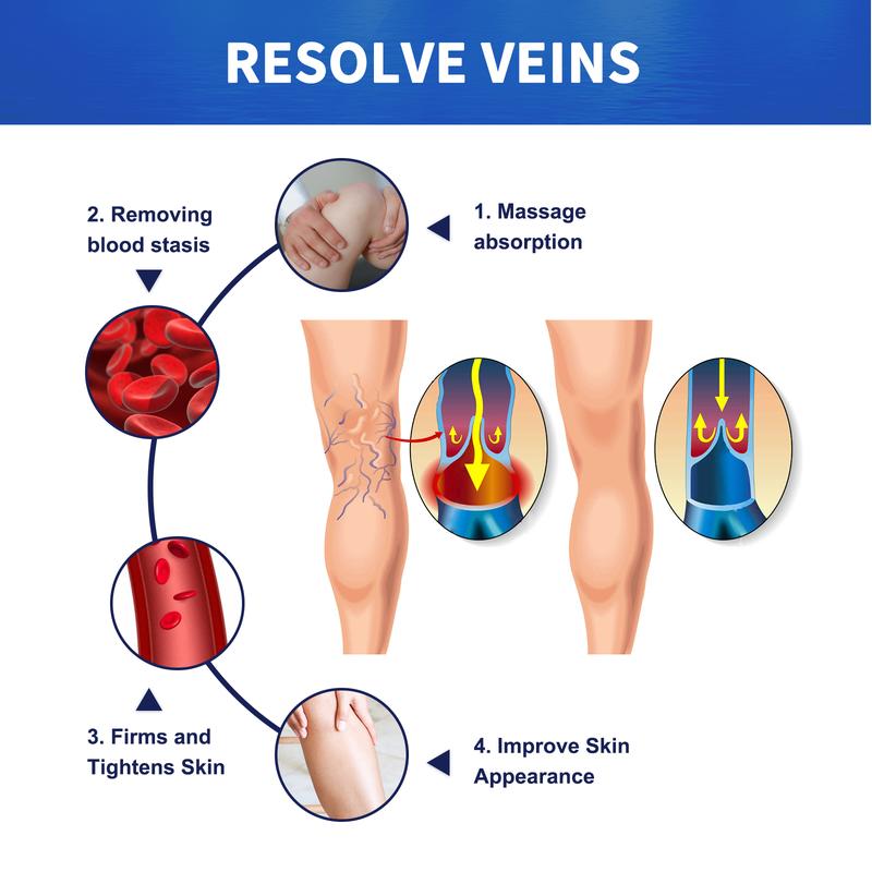 Product Introduction of South Moon Pijat Vena Varises Krim Perbaikan Kaki Cacing Tanah Meringankan Vena Varises yang Menonjol di Kaki Extract Ceramide 7