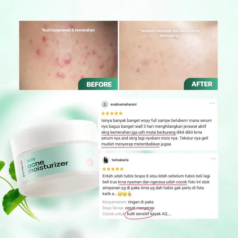[NEW] Acneno Daily Acne Moisturizer isi 30gr | Melembabkan & Memperbaiki Skin Barrier Dengan Kandungan Panthenol  | Mencegah Jerawat | Aman Untuk Bumil & Busui | BPOM Original 5