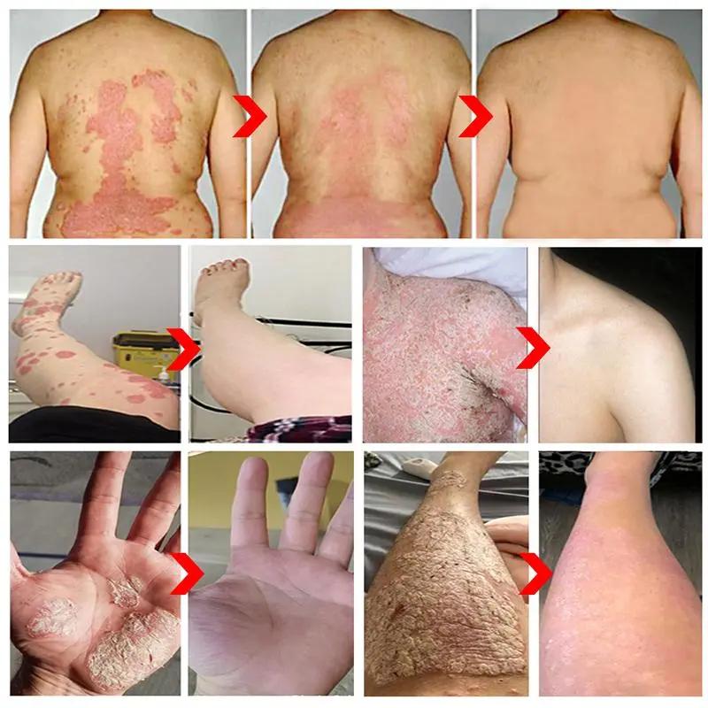 Salep gatal Salep Eksim Salep kulit Krim psoriasis paling ampuh Kulit Kepala Psoriasis Tangan Tinea Kaki Bau Versicolor Menghambat Dermatitis Jamur Anti Gatal Cream 20G