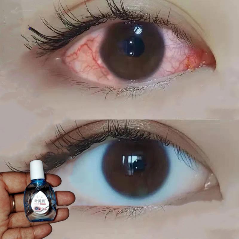 Eye Drops for Cataracts, Dry Eyes, Eye Pain, Red Bloodshot Eyes, Eye Strain 1