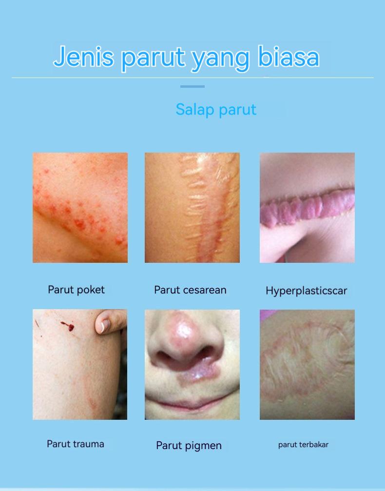 【COD】Krim Perbaiki Bekas Lahir & Parut - Memperbaiki dan Menyembuhkan Tato, Parut, dan Luka Jahitan Operasi - 20g