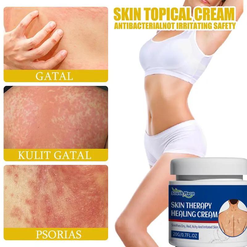 Salep gatal Salep Eksim Salep kulit Krim psoriasis paling ampuh Kulit Kepala Psoriasis Tangan Tinea Kaki Bau Versicolor Menghambat Dermatitis Jamur Anti Gatal Cream 20G