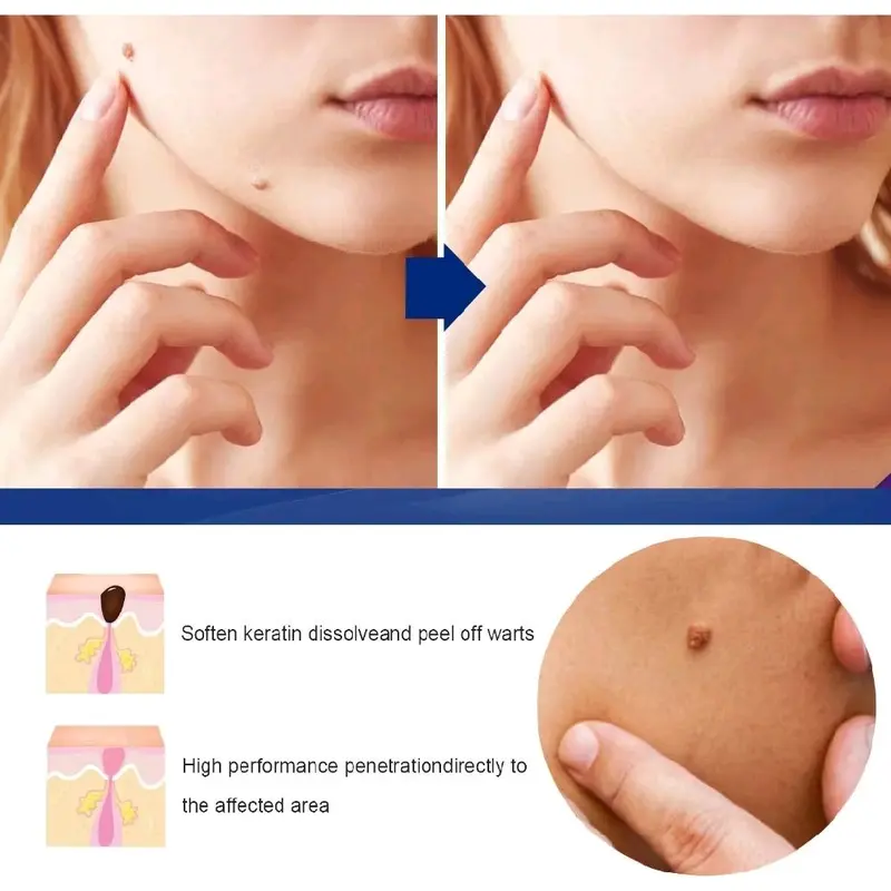 Cream Penghilang Tai Lalat Kutil Ampuh Wart Remover Skin Tag Oitment 3