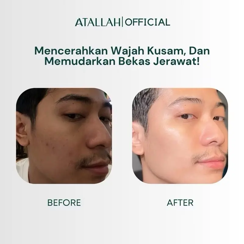 [FLASH SALE] ATALLAH 5Pcs Paket Glow Up Basic Skincare Brightening set | Pencerah Wajah | Menghilangkan Flek Hitam | Spf 50 PA +++ 1