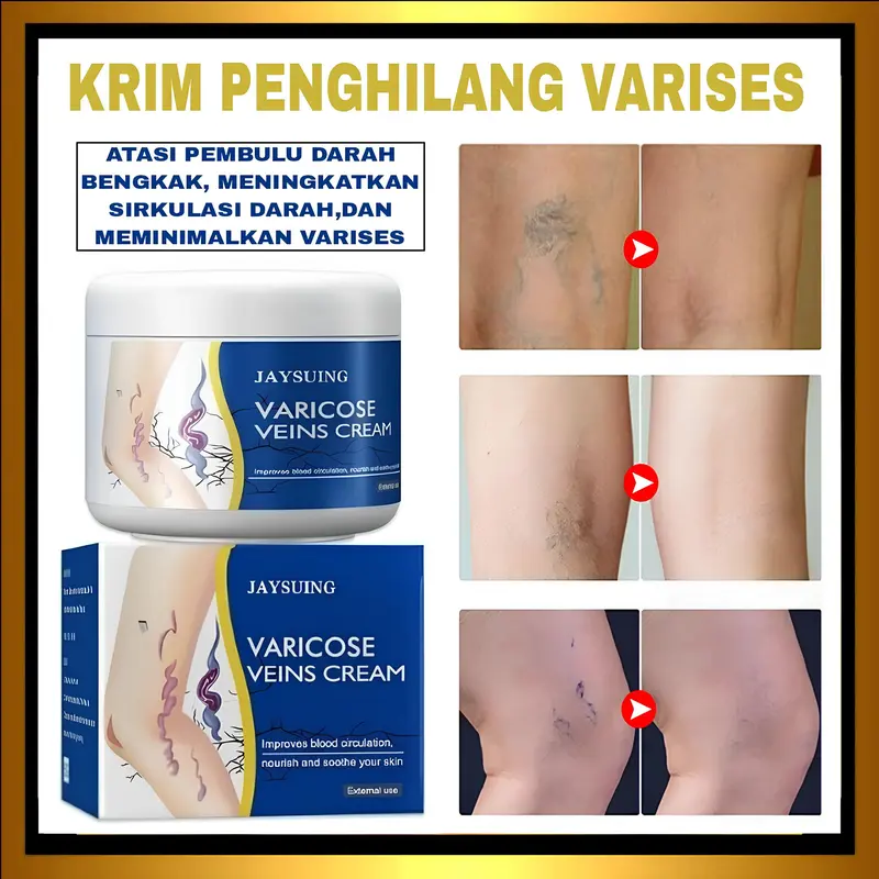 Jaysuing Varicose Veins Cream Membantu Meingkatkan Sirkulasi Darah Dan Menghilangkan Varises 0